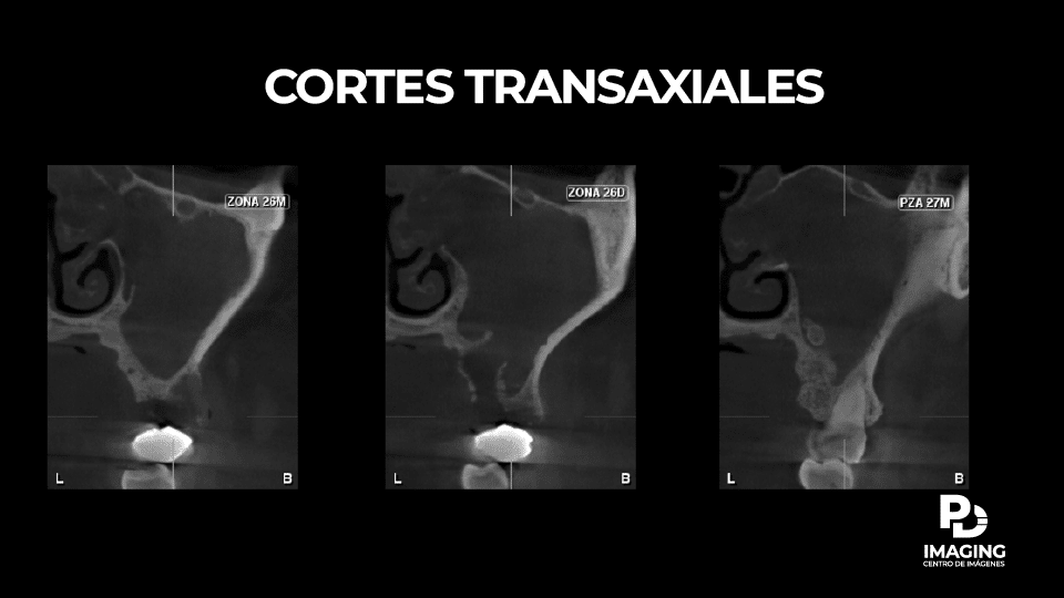 Cortes transaxiales mostrando el compromiso de la sinusitis odontogénica hacia el cornete medio