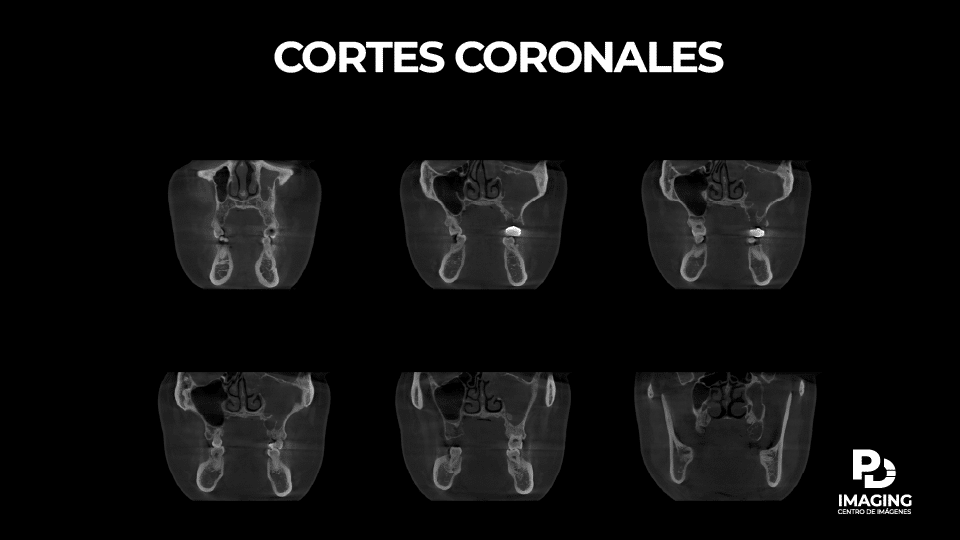 Cortes coronales de CBCT evidenciando sinusitis odontogénica por pérdida de continuidad del piso del seno maxilar
