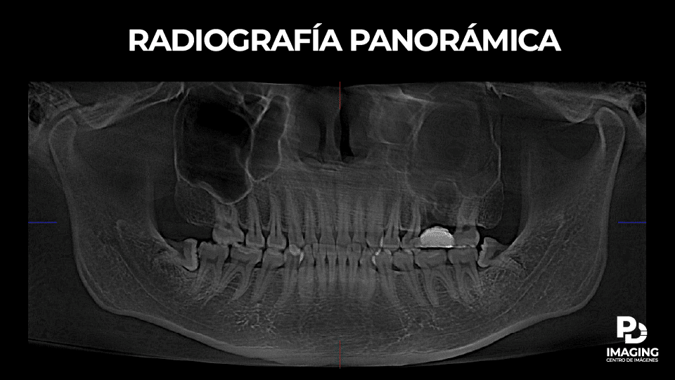 Análisis de tomografía cone beam 3d en lima para diagnóstico de sinusitis odontogénica